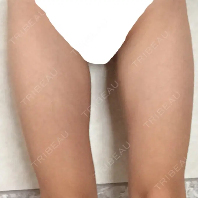 脂肪溶解注射（太もも） 湘南美容クリニック 仙台院 DAY 26 メイン用