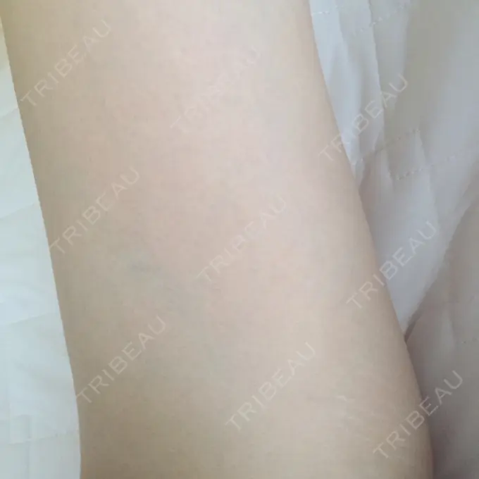 脂肪溶解注射（太もも） 湘南美容クリニック 仙台院 DAY 26 メイン用