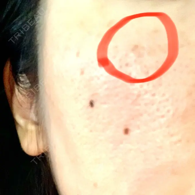 シミ取りレーザー Dual Clinic KOBE DAY 31 メイン用