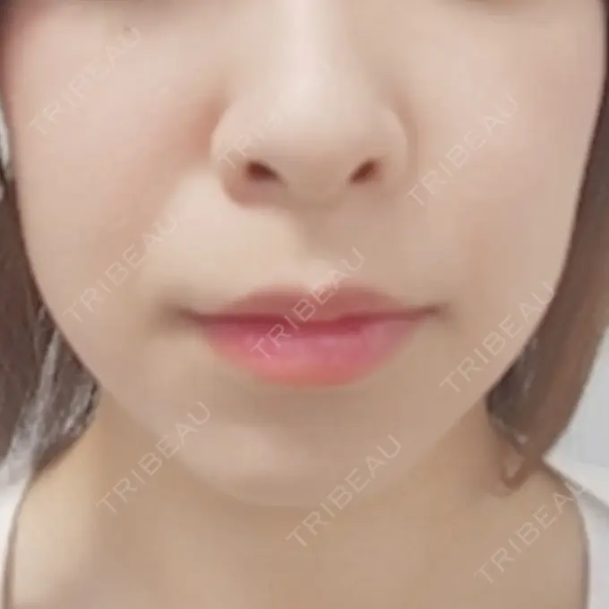 脂肪溶解注射（顔） 新宿美容外科クリニック 新宿院 DAY 7 メイン用