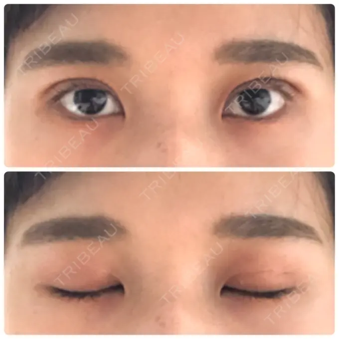 二重埋没 湘南美容クリニック 赤坂見附院 DAY 24 メイン用