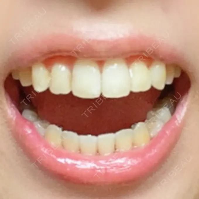 矯正（ワイヤー） アトラスタワー歯科 DAY 217 メイン用