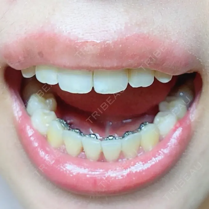 矯正（ワイヤー） アトラスタワー歯科 DAY 217 メイン用