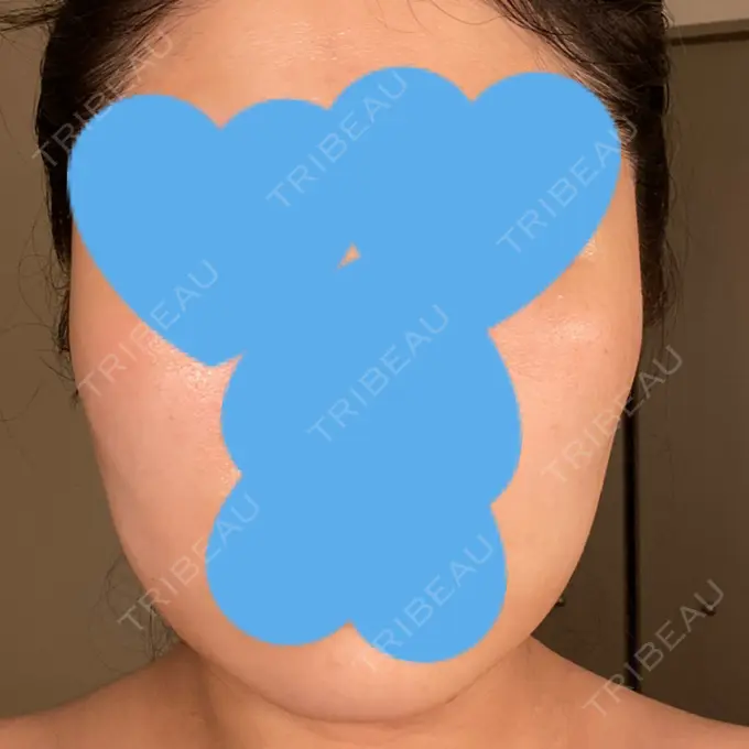 脂肪溶解注射（顔） ビクアスクリニック DAY 28 メイン用