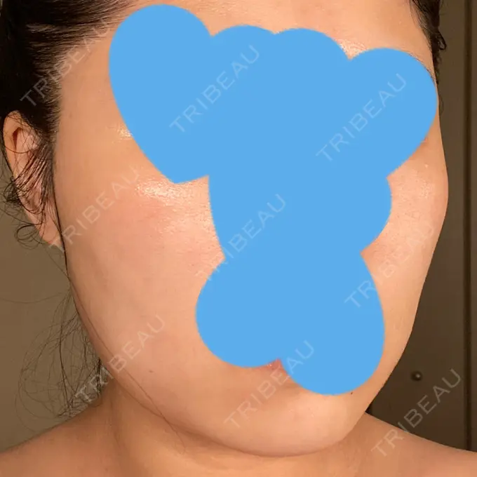 脂肪溶解注射（顔） ビクアスクリニック DAY 28 メイン用