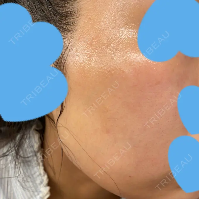 ピコレーザートーニング（美白・肝斑） UB CLINIC銀座 DAY 25 メイン用