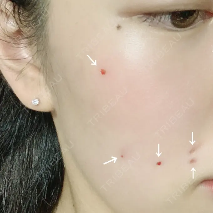 ほくろ・いぼ切除（肌） 品川スキンクリニック大宮院 DAY 11 メイン用