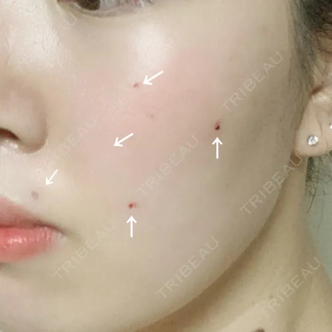 ほくろ・いぼ切除（肌） 品川スキンクリニック大宮院 DAY 11 メイン用