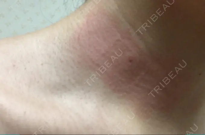 ほくろ・いぼ切除（肌） 医療法人美彩会 グランクリニック DAY 3 メイン用