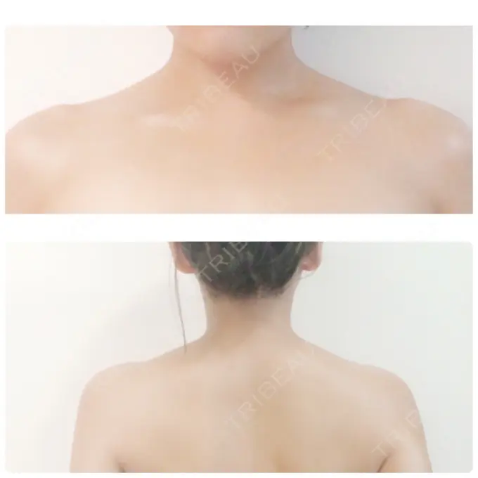 ボトックス（肩） ヴェルトラクリニック 大阪院 DAY 15 メイン用