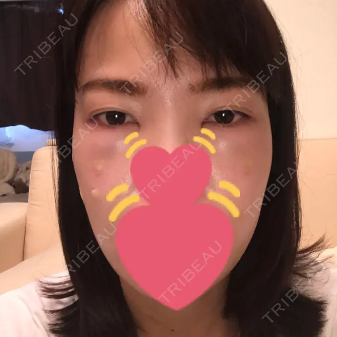 脂肪溶解注射（まぶた） / PRP皮膚再生療法 プルージュ美容クリニック 赤羽院 DAY 2 メイン用