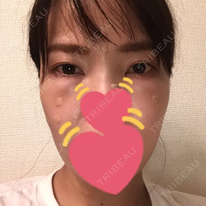 脂肪溶解注射（まぶた） / PRP皮膚再生療法 プルージュ美容クリニック 赤羽院 DAY 3 メイン用