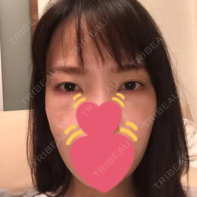 脂肪溶解注射（まぶた） / PRP皮膚再生療法 プルージュ美容クリニック 赤羽院 DAY 4 メイン用