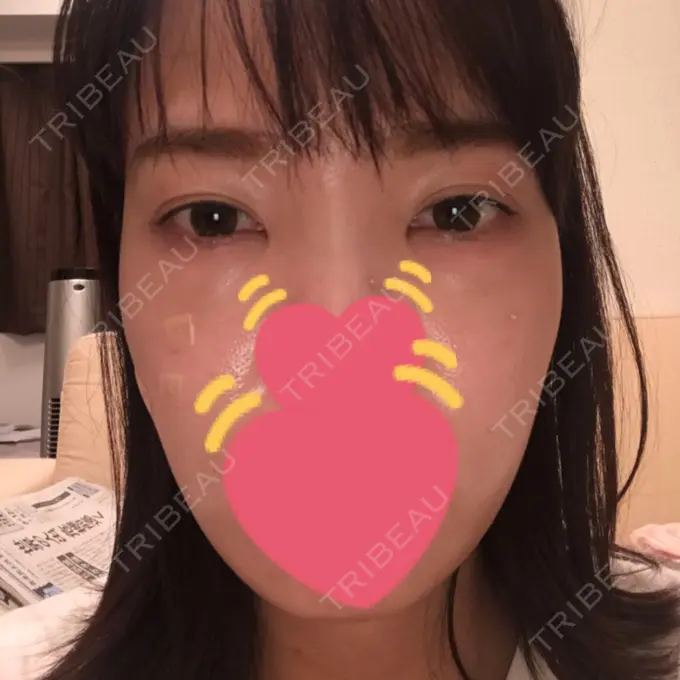 脂肪溶解注射（まぶた） / PRP皮膚再生療法 プルージュ美容クリニック 赤羽院 DAY 5 メイン用