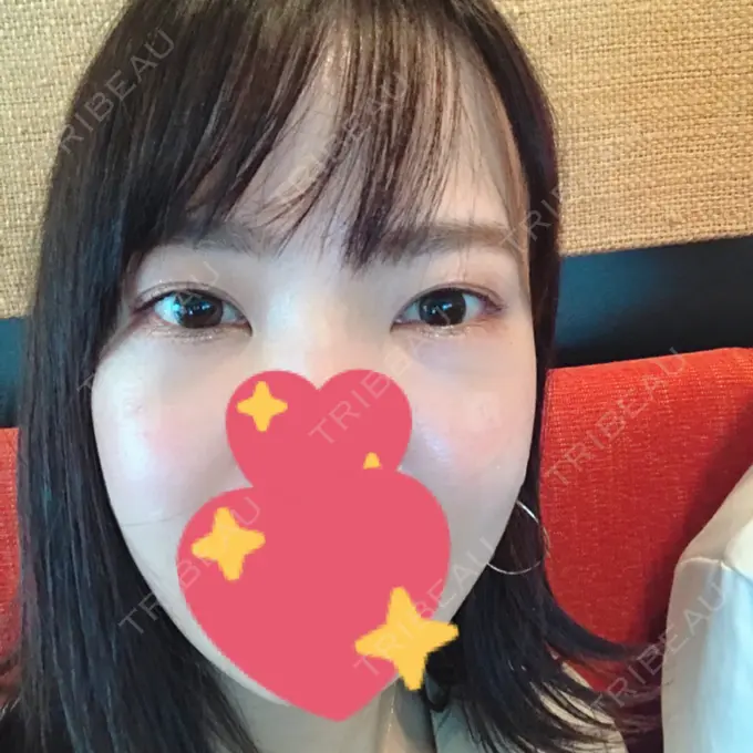 脂肪溶解注射（まぶた） / PRP皮膚再生療法 プルージュ美容クリニック 赤羽院 DAY 7 メイン用