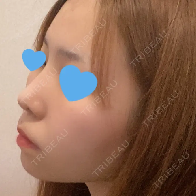 鼻尖形成（切開） / 鼻中隔延長（切開） / 軟骨移植 / 鼻孔縁下降 / その他（鼻） 湘南美容クリニック 新宿本院 DAY 63 メイン用