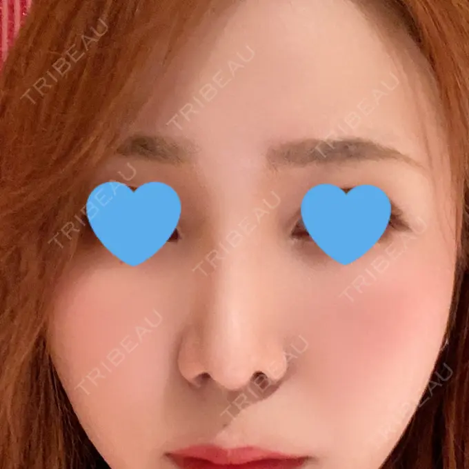 鼻尖形成（切開） / 鼻中隔延長（切開） / 軟骨移植 / 鼻孔縁下降 / その他（鼻） 湘南美容クリニック 新宿本院 DAY 63 メイン用