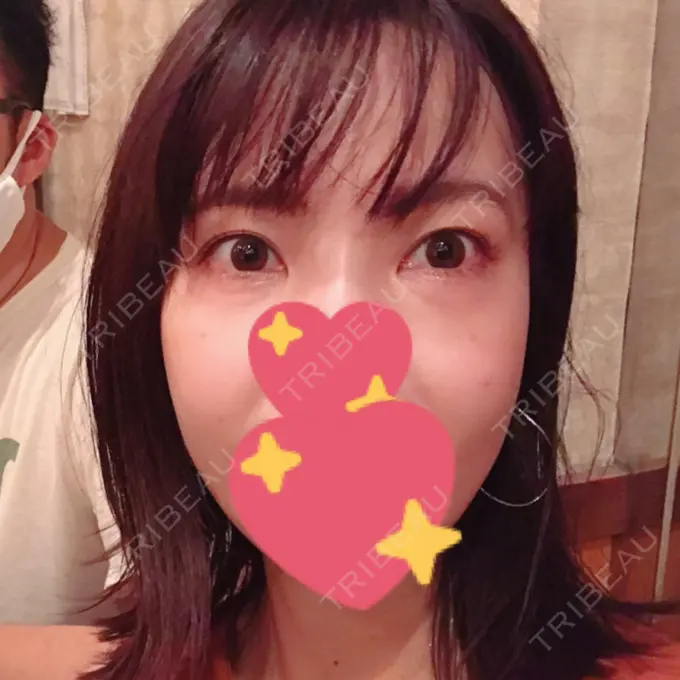 脂肪溶解注射（まぶた） / PRP皮膚再生療法 プルージュ美容クリニック 赤羽院 DAY 9 メイン用