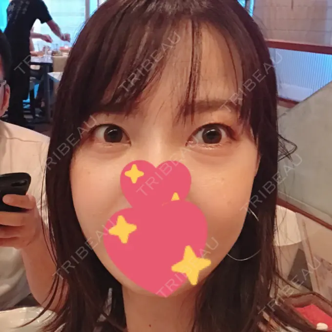 脂肪溶解注射（まぶた） / PRP皮膚再生療法 プルージュ美容クリニック 赤羽院 AFTER メイン用