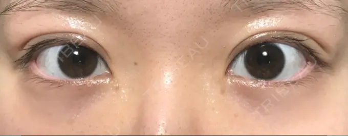 二重切開 きくな湯田眼科 DAY 21 メイン用