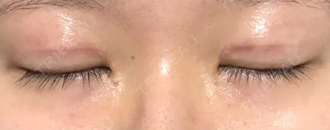 二重切開 きくな湯田眼科 DAY 21 メイン用