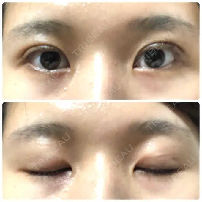 二重埋没 湘南美容クリニック 赤坂見附院 DAY 28 メイン用