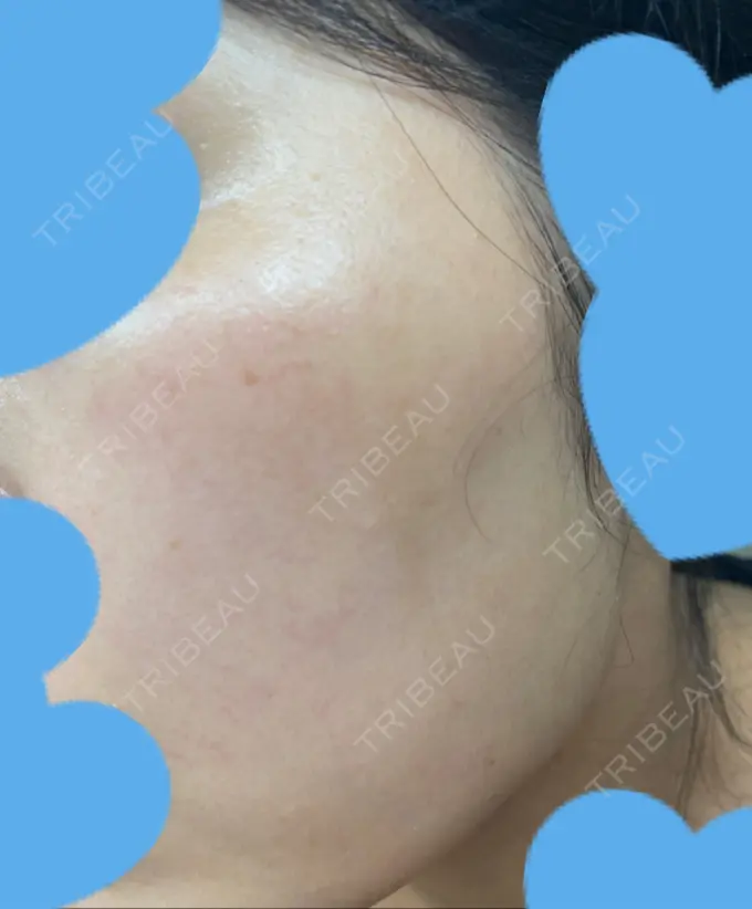 ピコレーザートーニング（美白・肝斑） UB CLINIC銀座 DAY 27 メイン用