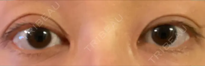 二重切開 / 目頭切開 きくな湯田眼科 DAY 64 メイン用