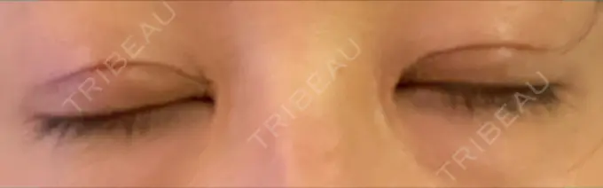 二重切開 / 目頭切開 きくな湯田眼科 DAY 64 メイン用