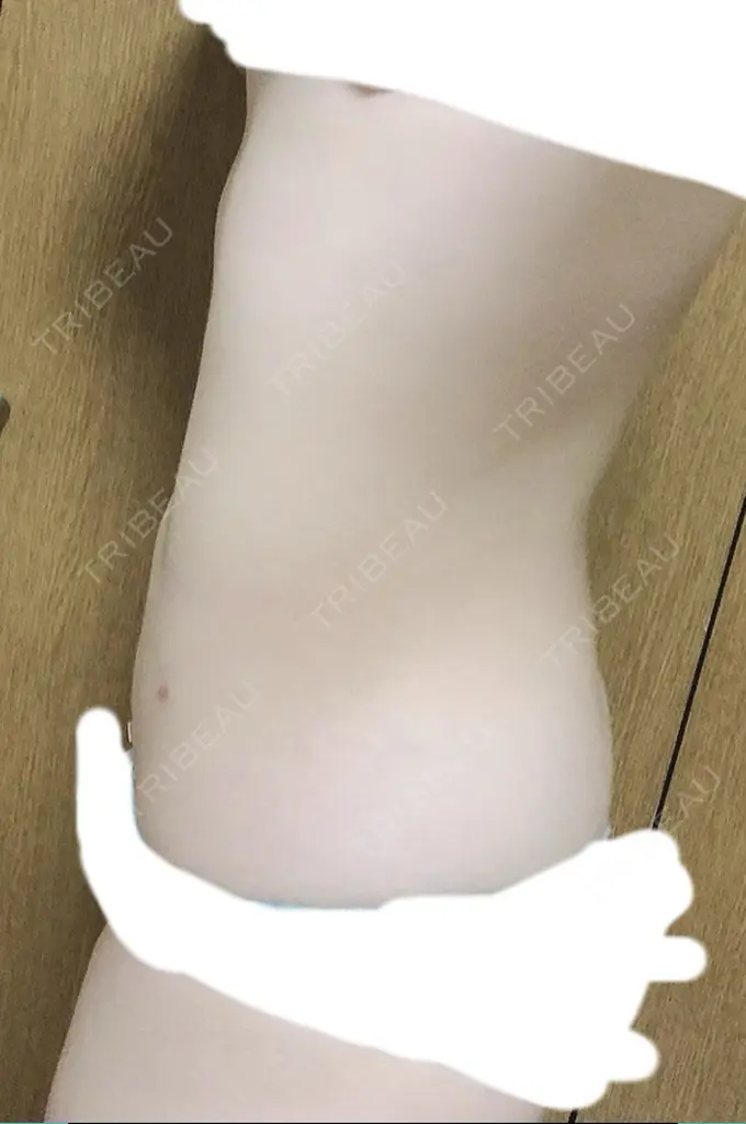 脂肪吸引（お腹） 石倉クリニック 水戸院 DAY 82 メイン用