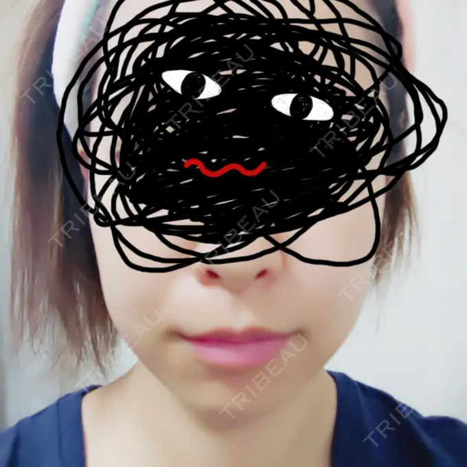 脂肪溶解注射（顔） 新宿美容外科クリニック 新宿院 DAY 8 メイン用