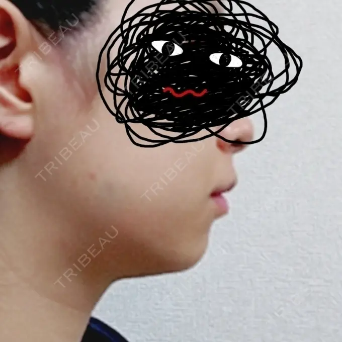 脂肪溶解注射（顔） 新宿美容外科クリニック 新宿院 DAY 8 メイン用