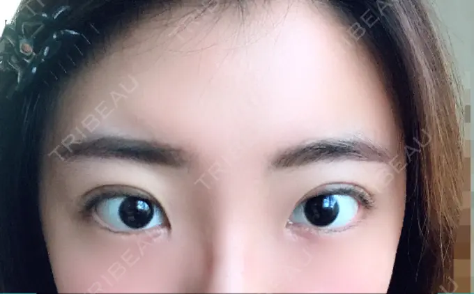 二重埋没 恵聖会クリニック 京橋院 DAY 2 メイン用