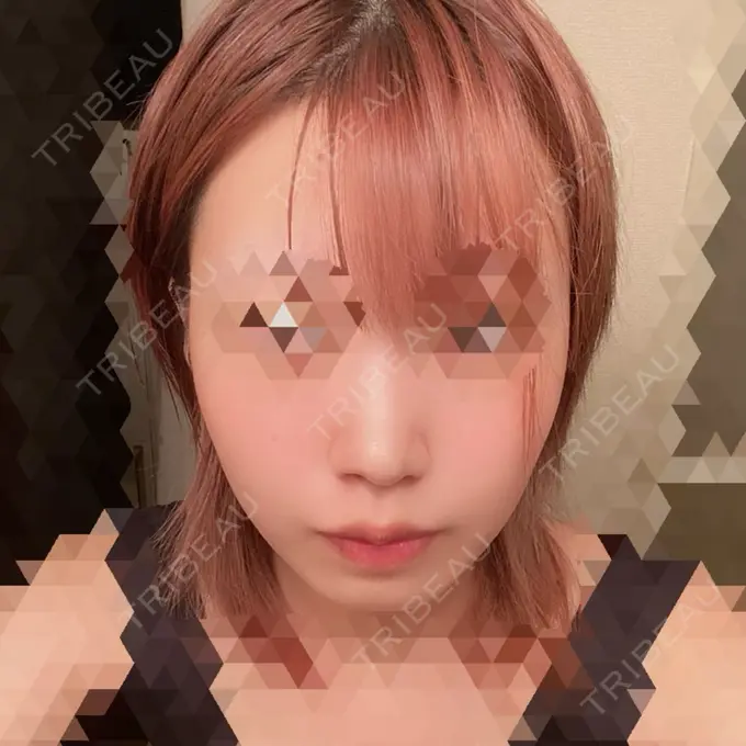 脂肪溶解注射（顔） TCB東京中央美容外科 心斎橋筋院 AFTER メイン用