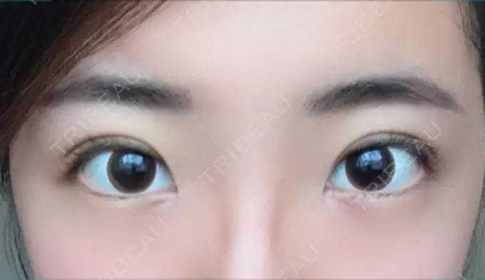 二重埋没 恵聖会クリニック 京橋院 DAY 3 メイン用