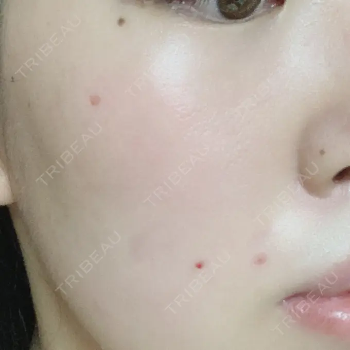 ほくろ・いぼ切除（肌） 品川スキンクリニック大宮院 DAY 15 メイン用