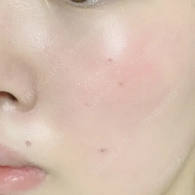 ほくろ・いぼ切除（肌） 品川スキンクリニック大宮院 DAY 15 メイン用