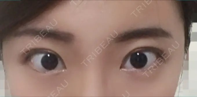 二重埋没 恵聖会クリニック 京橋院 DAY 4 メイン用