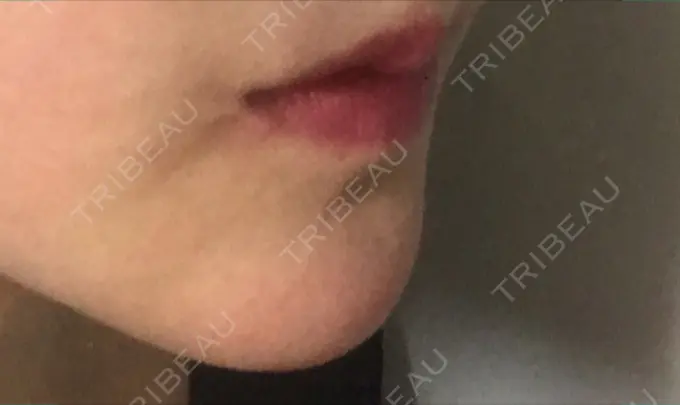 口角挙上 現代美学整形外科 DAY 221 メイン用