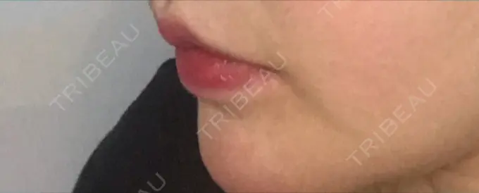 口角挙上 現代美学整形外科 DAY 221 メイン用