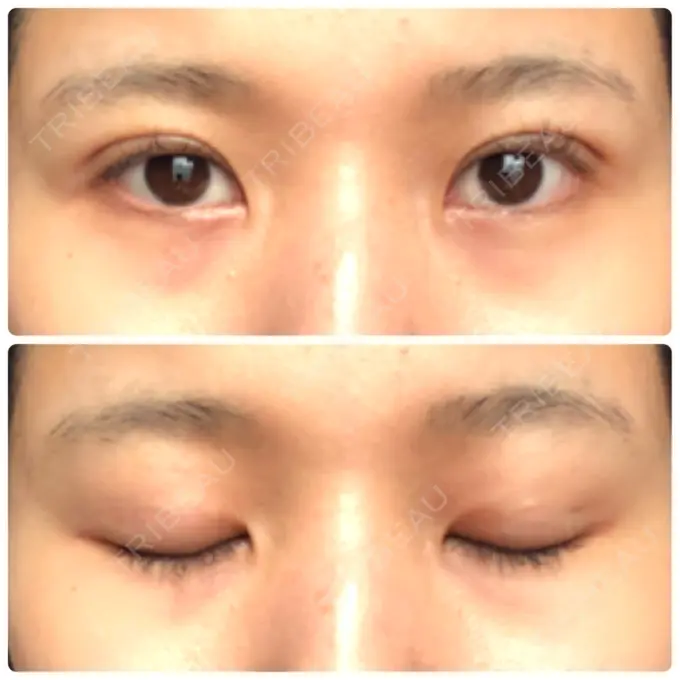 二重埋没 湘南美容クリニック 赤坂見附院 DAY 33 メイン用