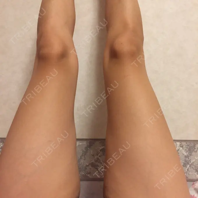 脂肪溶解注射（太もも） 湘南美容クリニック 仙台院 AFTER メイン用