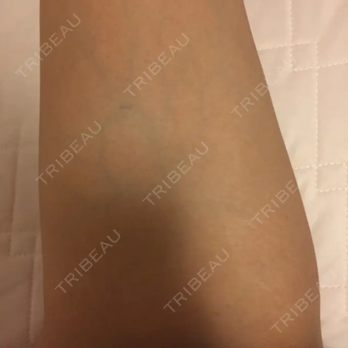 脂肪溶解注射（太もも） 湘南美容クリニック 仙台院 DAY 28 メイン用