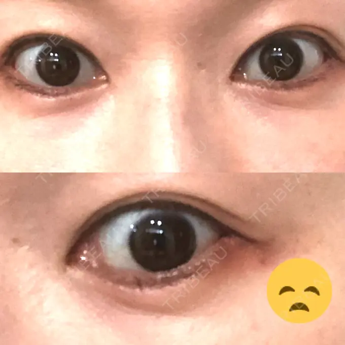 ヒアルロン酸注入（涙袋） Wクリニック 心斎橋院 DAY 1 メイン用