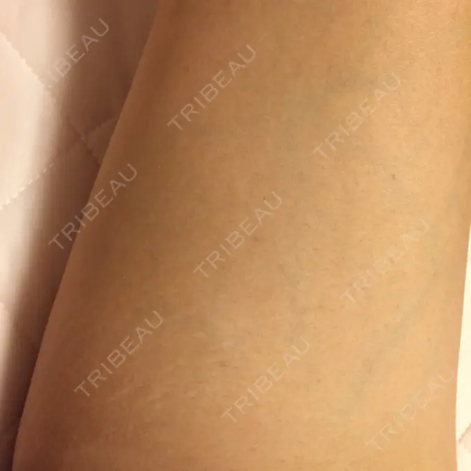 脂肪溶解注射（太もも） 湘南美容クリニック 仙台院 DAY 28 メイン用