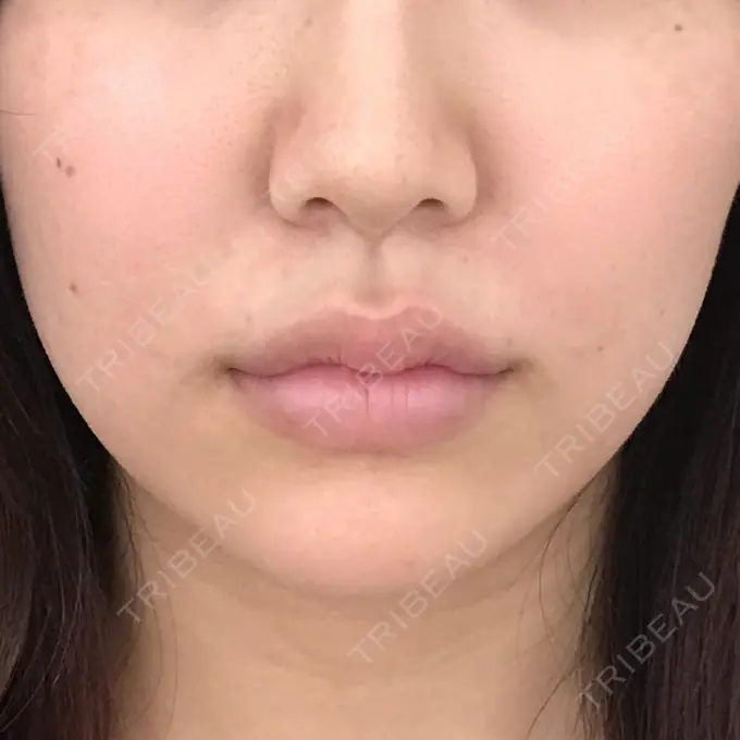 その他（肌） A CLINIC（エークリニック） 横浜院 AFTER メイン用