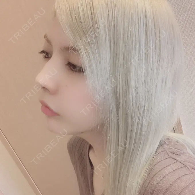 ガミースマイル手術 / セットバック / ルフォー+ssro（両あご) / 輪郭修正 / 矯正（ワイヤー） クラインデンタルクリニック DAY 170 メイン用