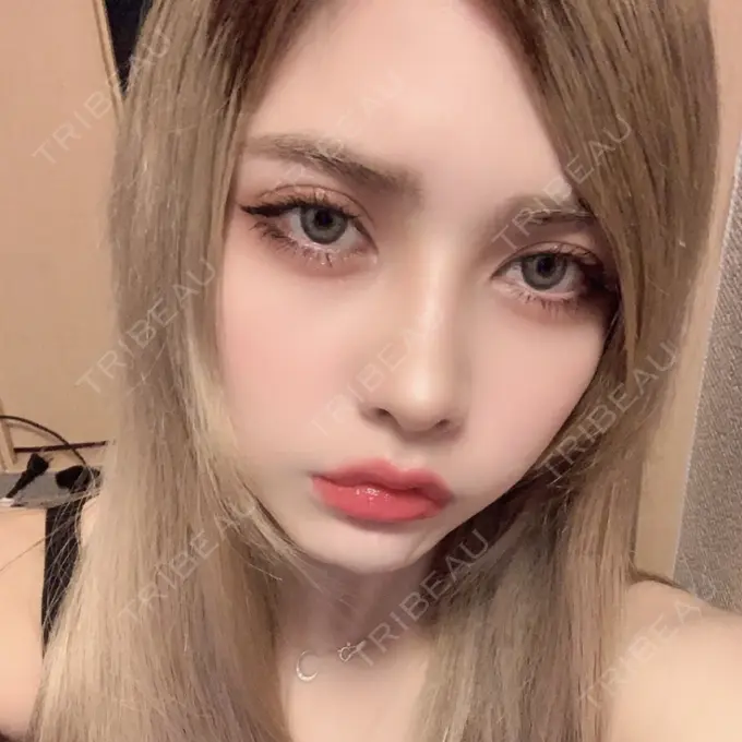 ガミースマイル手術 / セットバック / ルフォー+ssro（両あご) / 輪郭修正 / 矯正（ワイヤー） クラインデンタルクリニック AFTER メイン用