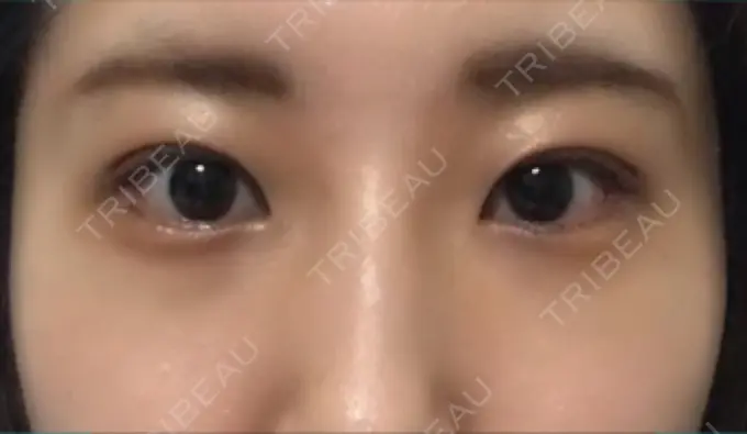 目尻切開 / タレ目形成・グラマラスライン（切開） A CLINIC（エークリニック） 銀座院 DAY 5 メイン用