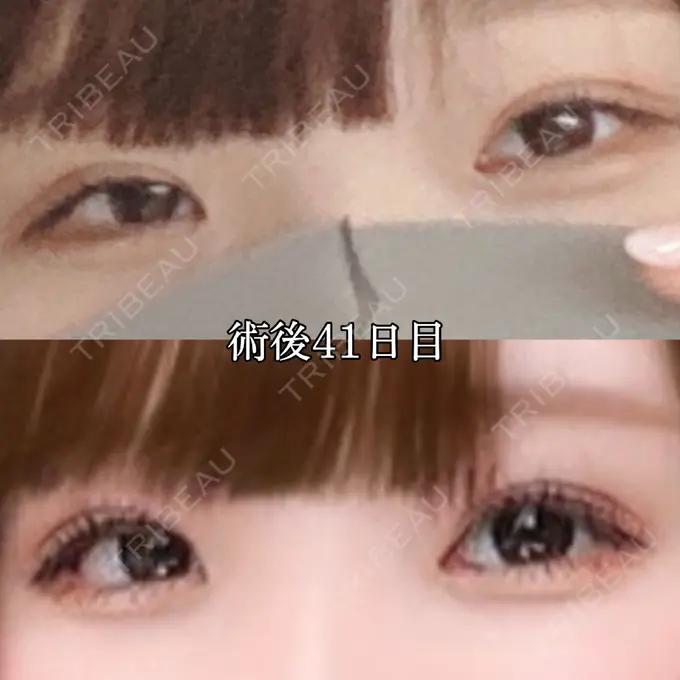 二重埋没 湘南美容クリニック 赤坂見附院 DAY 42 メイン用